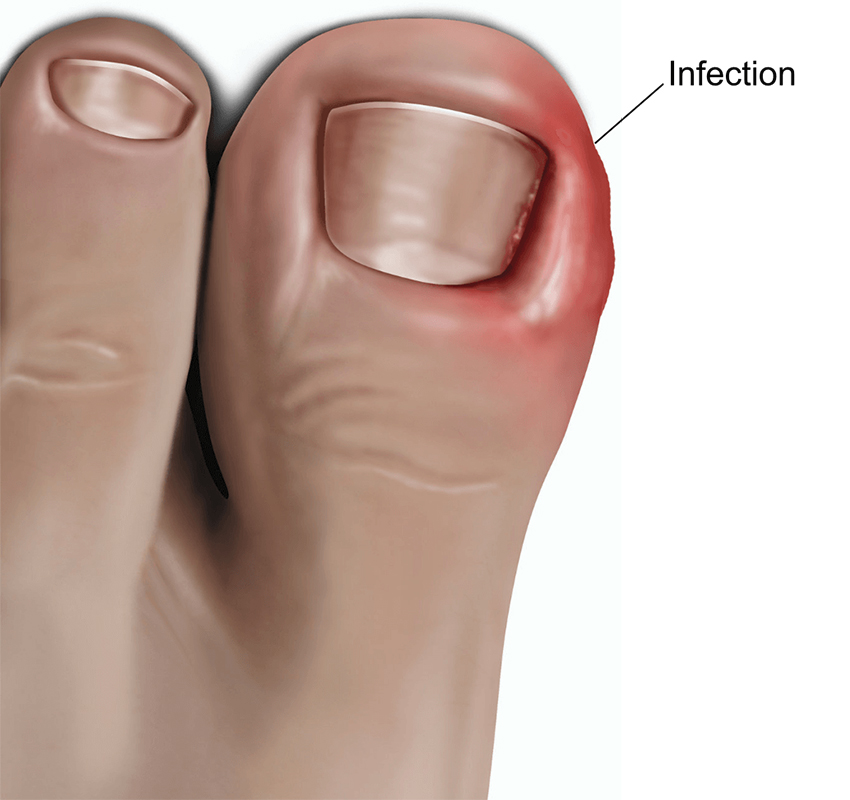 Surgery for ingrowing toenail (adult) | healthdirect