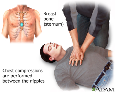 CPR - adult - series—Chest compressions: MedlinePlus Medical Encyclopedia